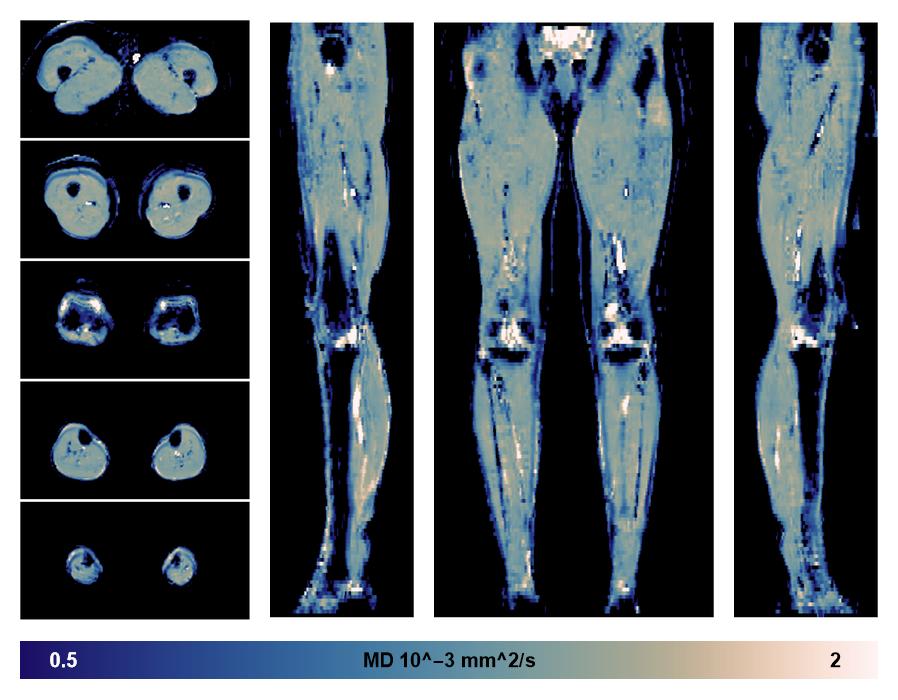 IVIM corrected whole leg muscle mean diffusivity obtained from diffusion tensor imaging.